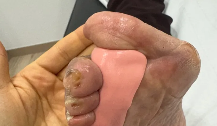 Ortesis a medida para helomas en Clínica Indipodo