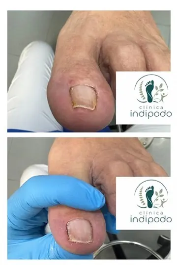 Uña clavada antes y después del tratamiento con ortonixia